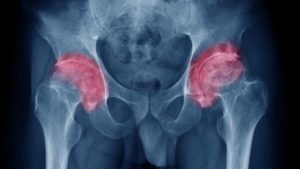 coxarthrose arthrose de la hanche traitement prothese de hanche chirurgien du rachis paris docteur antoine roul clinique drouot